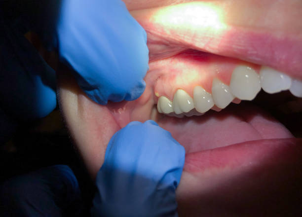 Best Broken Tooth Emergency  in White Sulphur Springs, WV