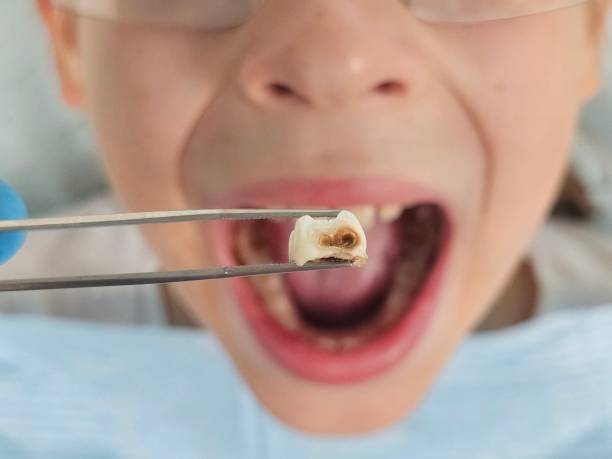 Best Urgent Tooth Repair  in White Sulphur Springs, WV